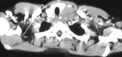 Lymphoma - CTisus CT Scan