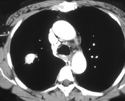 Calcified Lung Mass in Patient With Pemphigus - CTisus CT Scan