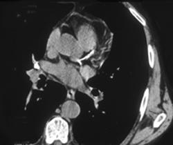 Left Coronary Artery Calcification - CTisus CT Scan