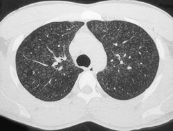 Pigeon Breeders Disease - Chest Case Studies - CTisus CT Scanning