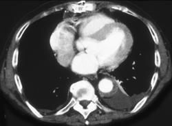 Intramural Hematoma Descending Aorta - CTisus CT Scan