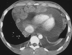 Lymphoma With Multiple Implants on Pericardium - CTisus CT Scan