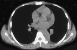 Pulmonary Embolism in Postpartum Patient (see Breasts) - CTisus CT Scan