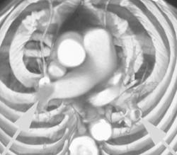 Pulmonary Embolism - CTisus CT Scan