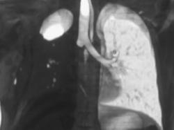 Right Pneumonectomy- Post Operative Study - CTisus CT Scan