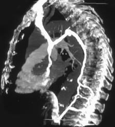 Dilated Azygos Vein - CTisus CT Scan