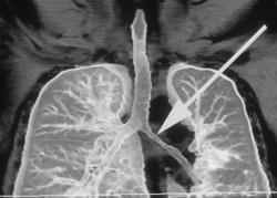 Stenosis of Left Mainstem Bronchus in Wegener's Granulomatosis - CTisus CT Scan