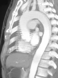 Motion Related Stair Stepping in Ascending Aorta Due to Cardiac Motion - CTisus CT Scan