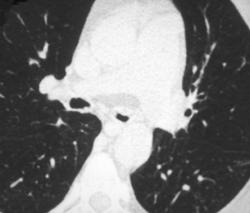 Wegener's Airway Causing Narrowing of Left Mainstem Bronchus - CTisus CT Scan