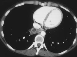 Sequestration - CTisus CT Scan