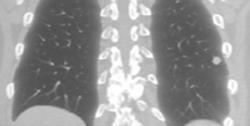 Solitary Pulmonary Nodule - CTisus CT Scan