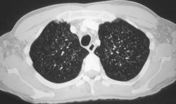 Tuberculosis (TB) - CTisus CT Scan