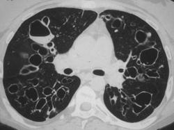 Cystic Fibrosis - CTisus CT Scan