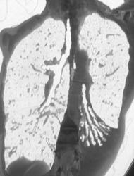 Bronchiectasis - CTisus CT Scan