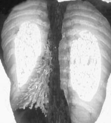 Bronchiectasis - CTisus CT Scan