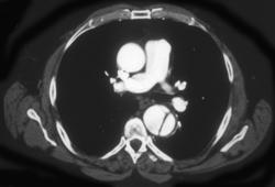 Aortic Dissection - CTisus CT Scan