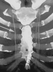 Normal Internal Mammary Arteries - CTisus CT Scan