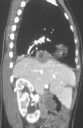 Implant on Diaphragm - CTisus CT Scan