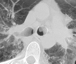 Endolumninal Lesion in Left Mainstem Bronchus - CTisus CT Scan