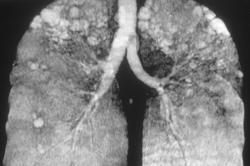 3D of Emphysema - CTisus CT Scan