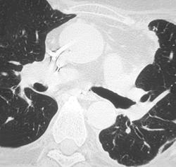 Narrowing Left Mainstem Bronchus at Anastomotic Site - CTisus CT Scan