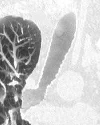 En Plaque Lesion in Trachea Due to Inflammation From Prior Endotracheal Tube - CTisus CT Scan