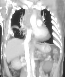 SVC Occlusion With Chest Wall Collaterals - CTisus CT Scan