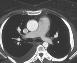 Coarctation of the Aorta Post Repair (look at the Size of the Descending Aorta) - CTisus CT Scan