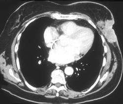 Recurrent Breast Cancer in Left Chest Wall - CTisus CT Scan