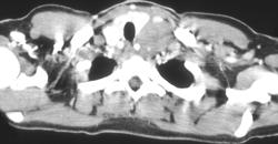 Lymphoma - CTisus CT Scan