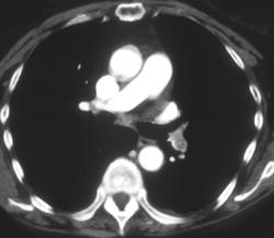 Pulmonary Embolism - CTisus CT Scan