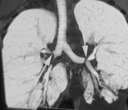 Stenosis of Both Mainstem Bronci at Anastomosis Post Transplant - CTisus CT Scan