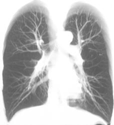 3D of Pulmonary Vasculature - CTisus CT Scan