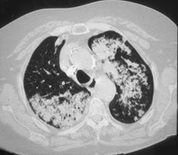 Pulmonary Hemorrhage - CTisus CT Scan