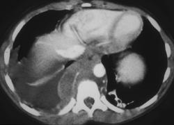 Posterior Mediastinal Nodes- Lymphoma - CTisus CT Scan