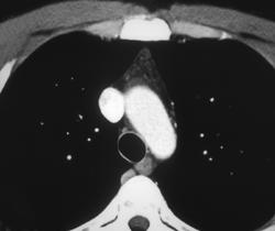 Minimal Residual Thymic Tissue - CTisus CT Scan