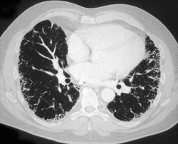 Idiopathic Pulmonary Fibrosis (IPF) - Chest Case Studies - CTisus CT