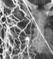 Chest Wall Collaterals - CTisus CT Scan