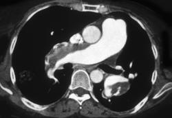 Multiple Huge Bilateral Chronic Pulmonary Emboli (PEs) - CTisus CT Scan