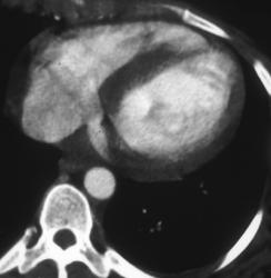 Sarcoidosis With Cardiac Involvement (septum) - CTisus CT Scan