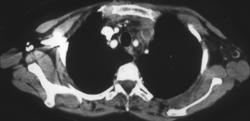 Jugular Vein Thrombosis Extends Downward - CTisus CT Scan