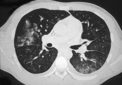 Cytomegalovirus (CMV) Pneumonitis - CTisus CT Scan