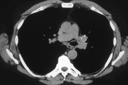 Tumor in Left Mainstem Bronchus - CTisus CT Scan