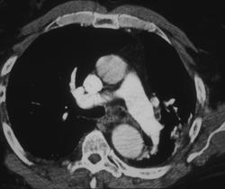 Narrowing Proximal Right Main Pulmonary Artery - CTisus CT Scan