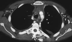 SVC Occlusion With Collaterals - CTisus CT Scan