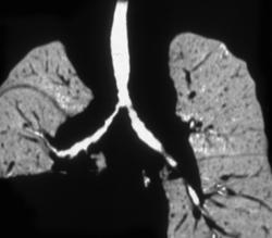 Airway Stenosis Due to Nodes - CTisus CT Scan