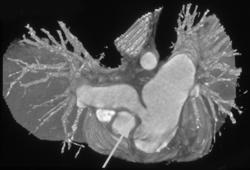 Narrowing of Right Main Pulmonary Artery - CTisus CT Scan