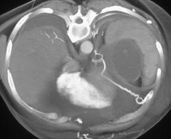 Collateral Vessel on Left Hemidiaphragm - CTisus CT Scan