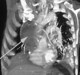 Lung Cancer With Mass - CTisus CT Scan