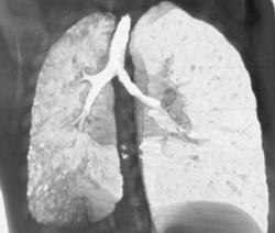 Hypoplastic Right Lung - CTisus CT Scan